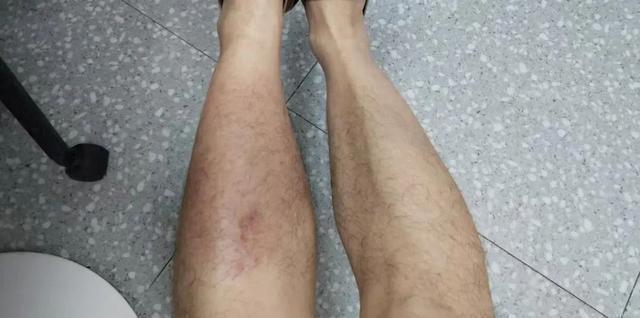 暴雨中蹚了一回水，男子高烧40℃还染上丹毒！医生提醒