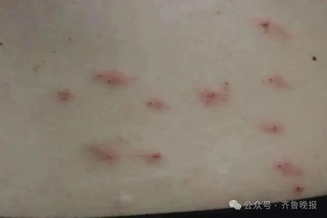 女子一觉醒来，身上密密麻麻！近期高发，很多人天天在用