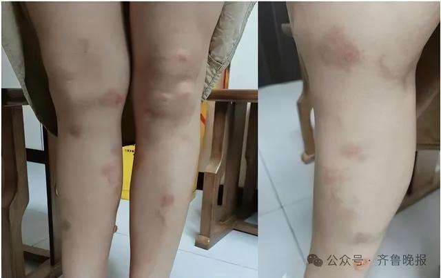 女子一觉醒来，身上密密麻麻！近期高发，很多人天天在用