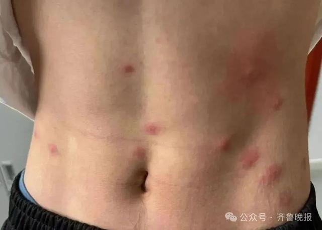 女子一觉醒来，身上密密麻麻！近期高发，很多人天天在用
