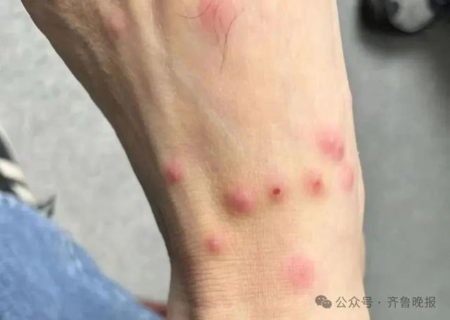 女子一觉醒来，身上密密麻麻！近期高发，很多人天天在用